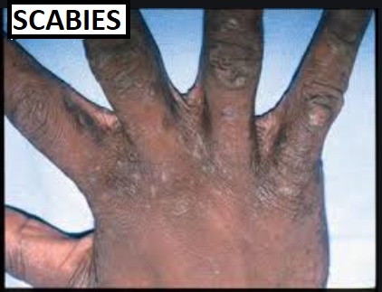 Sarcoptes Scabiei - Management of Scabies Today